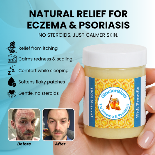 GlacierSkin - Repair Balm For Eczema & Psoriasis